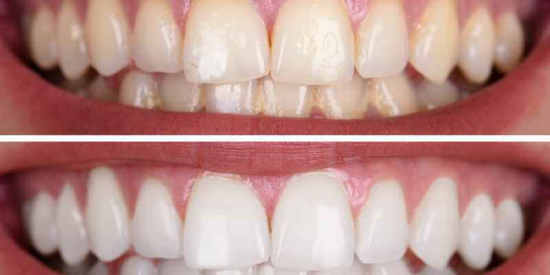 Teeth Whitening in Nampa ID